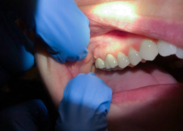 Best Urgent Care for Lost Fillings or Crowns in Park City, UT